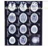 Custom 8 x 10 Digital Medical Dry Film X Ray