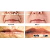 Sodium Hyaluronate Injection Beauty