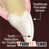 Lumineers Veneers